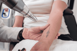 laser retirando tatuagem para representar Valor da remoção de tatuagem